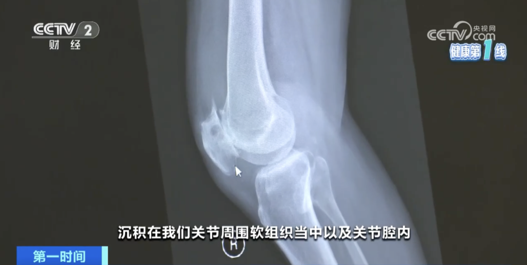 别被“沉默杀手”盯上！快看看体检单上的这个指标(图2)